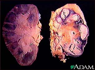 Tuberculosis in the kidney