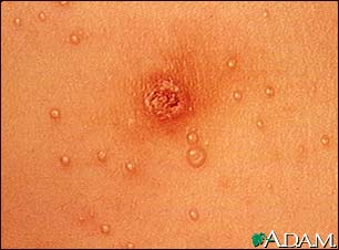 Molluscum contagiosum - close-up of the chest