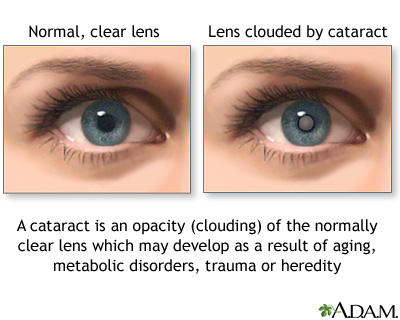 Cataract