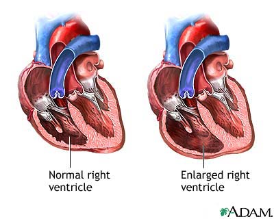 Tricuspid Regurgitation