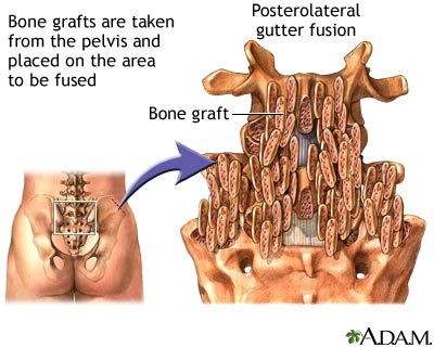 Procedure: Posterolateral gutter fusion