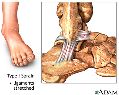 Type I ankle sprain