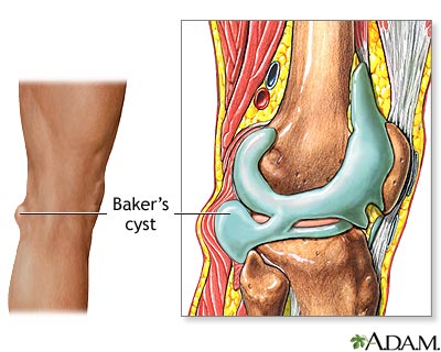 Baker's cyst