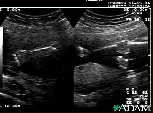 Ultrasound, normal fetus - arms and legs