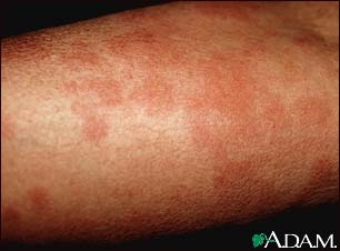 Hives (urticaria) on the arm