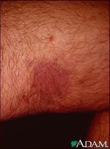 Kaposi's sarcoma on the thigh