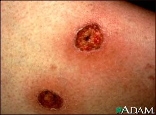 Ecthyma gangrenosum