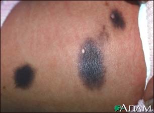 Congenital nevus on the abdomen