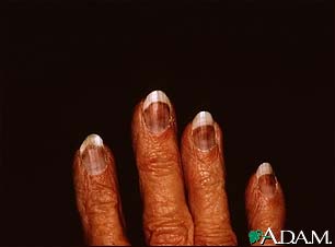 Cryoglobulinemia - fingers