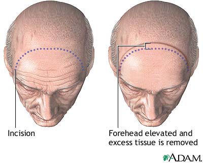 Procedure