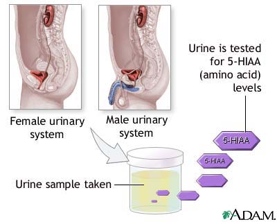 Aminoaciduria urine test