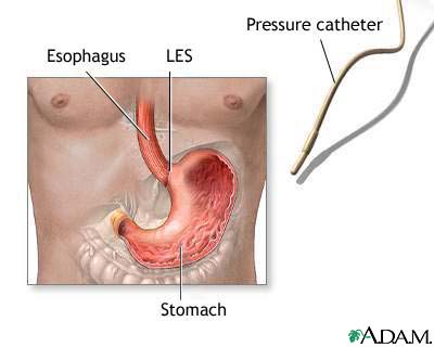 Esophageal manometry