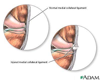 Torn medial collateral ligament