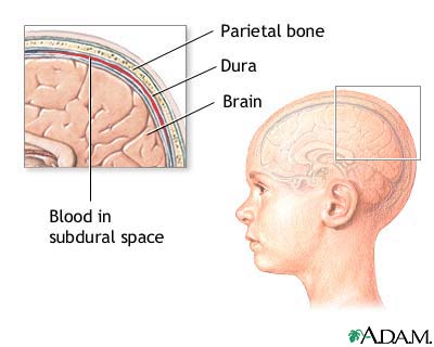 Increased intracranial pressure