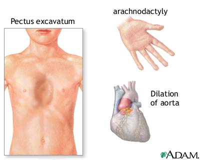 Marfan's syndrome