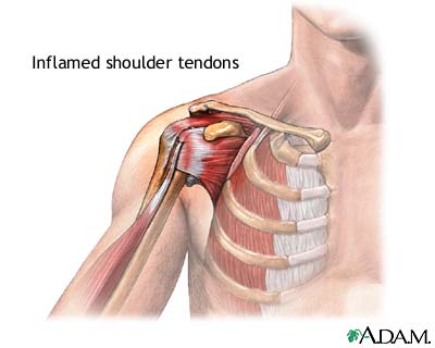 Inflamed shoulder tendons