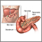 Pancreatitis - series