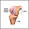 Partial knee replacement - series