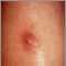 Keratoacanthoma
