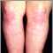 Dermatomyositis on the legs